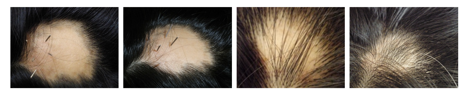 HAIR LOSS ACUPUNCTURE TREATMENT Lake Forest Irvine CA, Soo Health care -  Soo Health Care